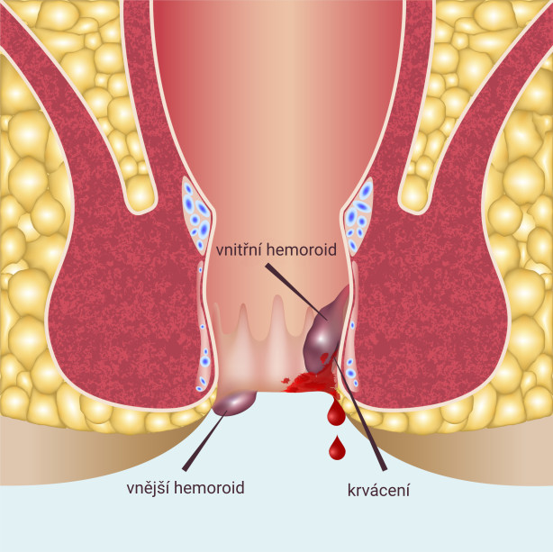 hemoroidy vnitřní a vnější